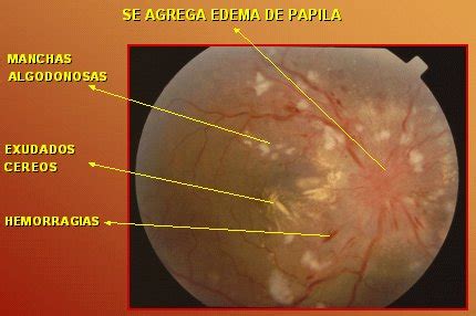 Compromiso ocular en la hipertensión arterial Medwave