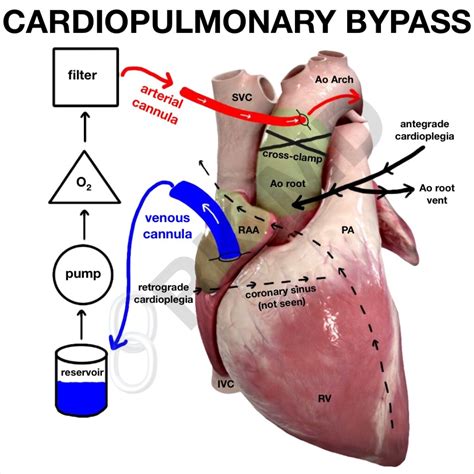 Cardiopulmonary Bypass Circuit Diagram Principles Of Cardiop