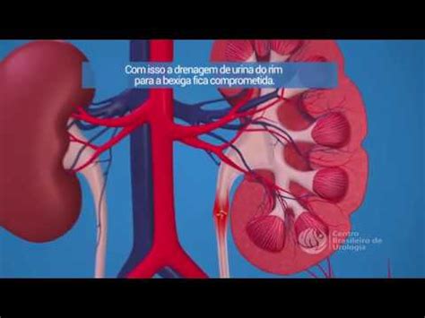 Retirada De C Lculo Renal Implante Duplo J Youtube