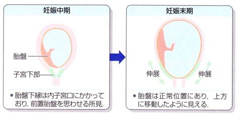 前置胎盤の診断 産婦人科専門医・周産期専門医からのメッセージ