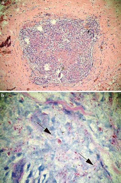 A The Caseating Granuloma With Epithelioid And Giant Cells As Seen In Download Scientific