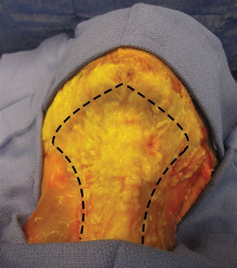 Figure 1 From Defining The Fat Compartments In The Neck A Cadaver