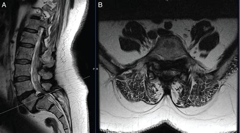 Robotics In Spine Surgery Beyond Pedicle Screw Placement Neupsy Key