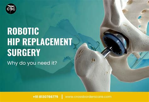 Robotic Hip Replacement Surgery Why Do You Need It