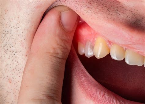 Qué Es La Periodoncia Y Cuáles Son Sus Tratamientos Valdivia Y Armijo