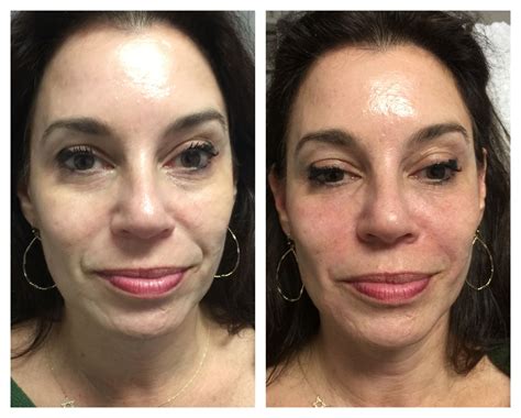 Bellafill To Nasolabial Fold Wrinkle And For Scar Reduction Right Chin