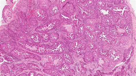 Intraductal Carcinoma Of The Salivary Glands Ottawa Atlas Of Pathology