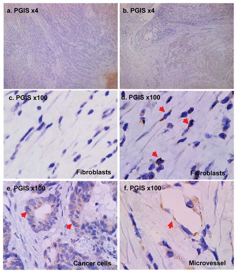 VEGF Expression Is Augmented By Hypoxiainduced PGIS In Human Fibroblasts