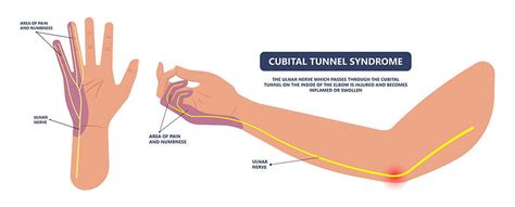 Cubital Tunnel Syndrome Musculoskeletal Ultrasound Injections