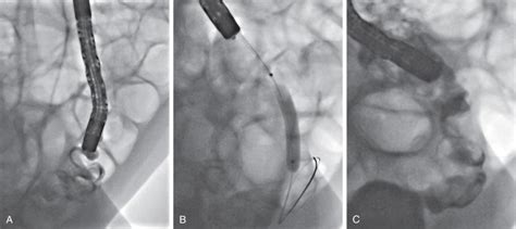 Acquired Lesions Of The Small Intestines Clinical Tree