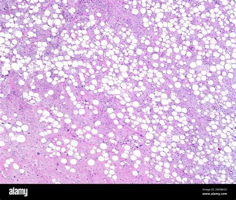 Well Differentiated Liposarcoma Light Micrograph Liposarcoma Is One