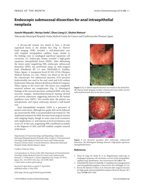 PDF Endoscopic Submucosal Dissection For Anal Intraepithelial Neoplasia