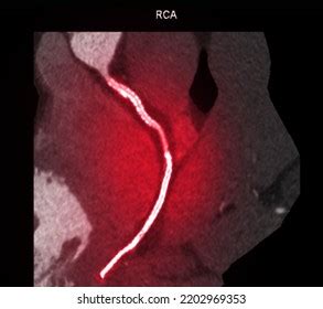 ct cardiac  cta coronary artery stock illustration