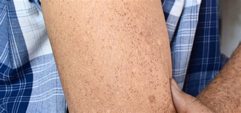 Skin Pigmentation Brown Patches