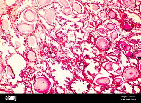 Hyperplasie De La Prostate Photomicrographe Montrant Les Glandes