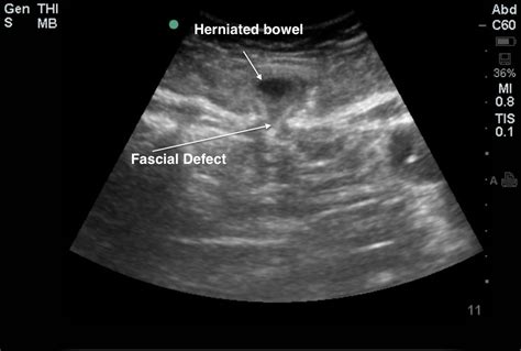 Abdominal Hernia Ultrasound