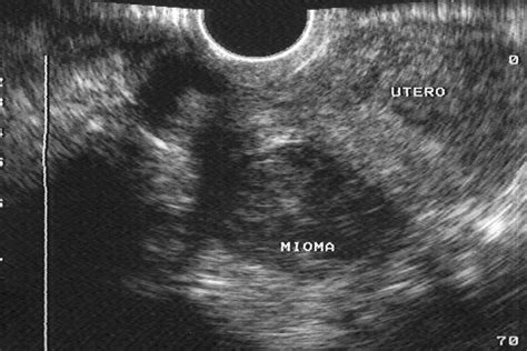 Miomatosis Uterina Gigante