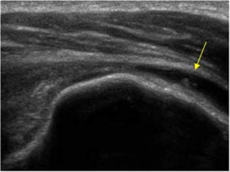 Shoulder Joint Ultrasound