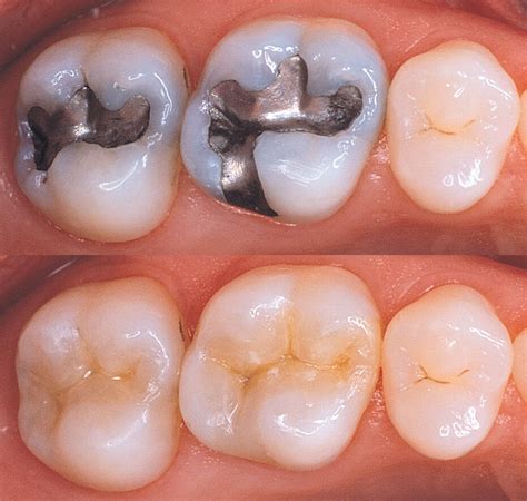 Tooth Colored White Fillings Dental Clinic In Lucknow Mint Dental