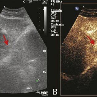 Ceus Pattern Of One Intrahepatic Splenosis Located Subcapsular And