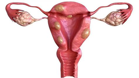 Miomatosis Uterina Dr Edwin H Veizaga Vargas Ginecólogo Obstetra Cochabamba