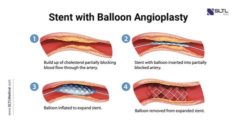 Everything You Need To Know About Angioplasty Sltl Group®