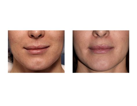 Plastic Surgery Case Study Perioral Mound Liposuction As An Aid For