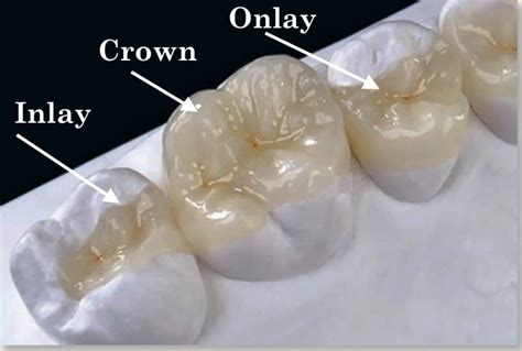 Inlays And Onlays Egg Harbor Township Dental Inlays Dental Onlays