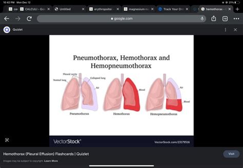 Chest Tubes Hemo And Pneumothorax Flashcards Quizlet