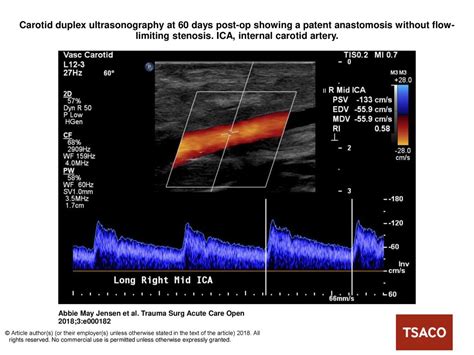 Carotid Duplex Ultrasonography At 60 Days Post Op Showing A Patent