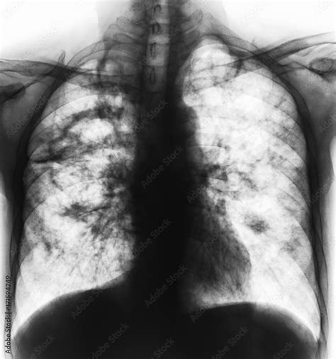 Pulmonary Tuberculosis Film X Ray Of Chest Show Cavity At Right Lung And Interstitial