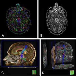 Diffusion Tensor Imaging With Tractography Fractional Anisotropy Maps