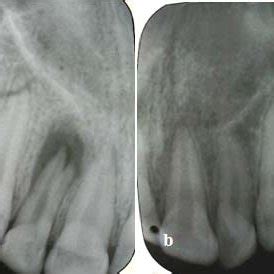 Pdf Endodontic Treatment Of A Maxillary Lateral Incisor With Two