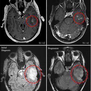 MRI of the CNS axis from case 4. (left) MRI of the brain with and... | Download Scientific Diagram