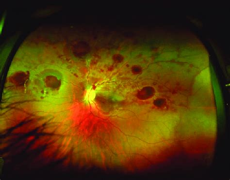 Wide Field Pseudo Color Fundus Image Of The Left Eye Shows Vasculitis