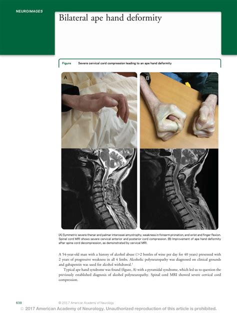 (PDF) Bilateral ape hand deformity