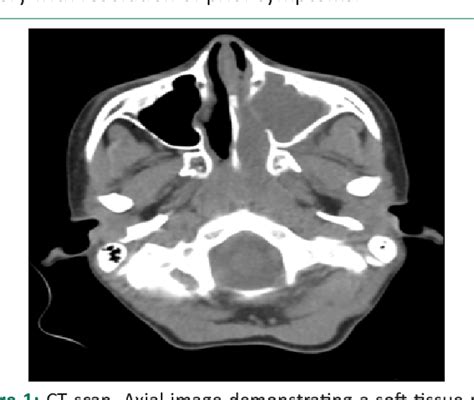 Figure 1 From Imaging Features Of Killian Polyp In The Maxillary Sinus Case Report And Review