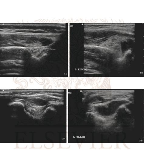 Elbow Effusion Ultrasound