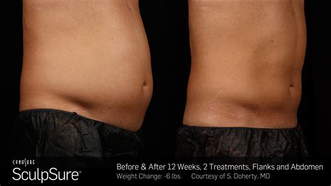 SculpSure Body Sculpting Seattle Lifted Beauty Wellness