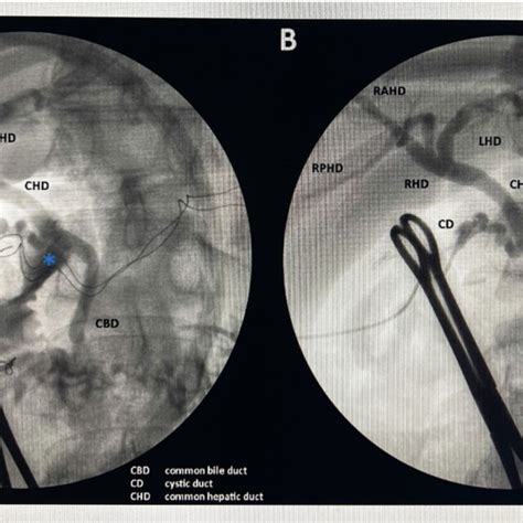 Intraoperative Cholangiogram A St Attempt Unusual Jet Of Contrast