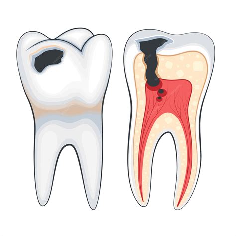 Premium Vector | Damaged tooth illustration, damaged teeth, dentist