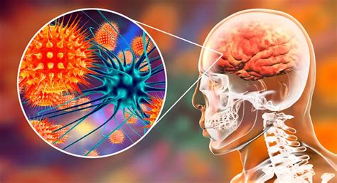 Síntomas del virus del Nilo Occidental y complicaciones