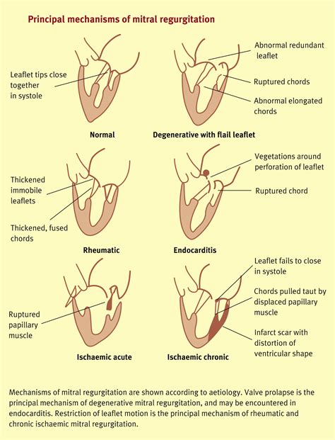 Mitral Valve Disease Medicine