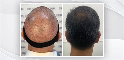 Hair Transplant Scars | DR. Emrah CINIK