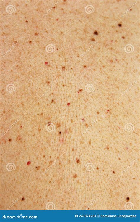 Moles And Birthmark On Human Skin Stock Photo Image Of Doctor Care