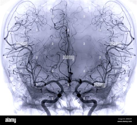 Cerebral Angiography Image From Fluoroscopy In Intervention Radiology