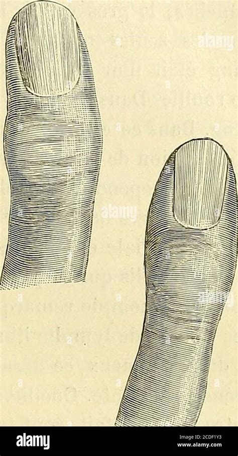 Les Types Articulations Hi Res Stock Photography And Images Alamy