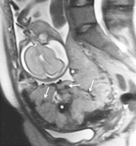 Sagittal Half Acquisition Single Shot Fast Spin Echo Ssfse Mri In A Download Scientific