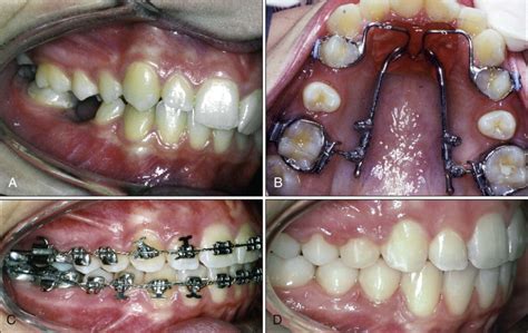 Class Ii Combination Therapy Molar Distalization And Fixed Functional Appliances Pocket Dentistry