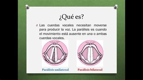 Parálisis De Las Cuerdas Vocales Youtube